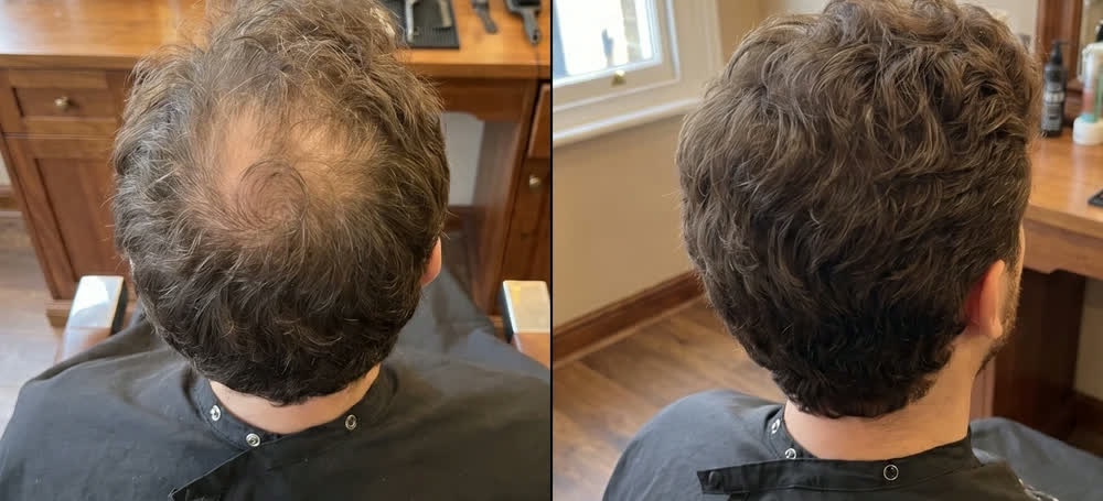 Prima — nuca con capelli ricci prima e dopo l'applicazione di Rootia castano medio