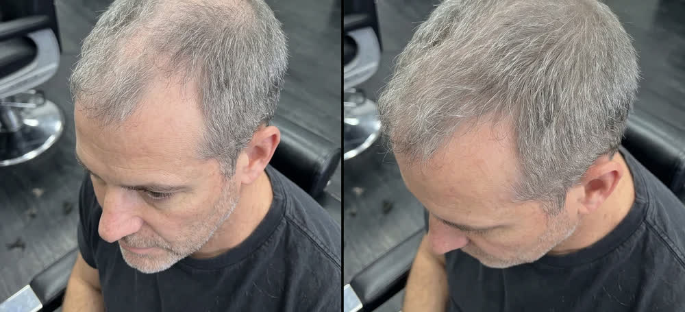 sommità diradata su capelli brizzolati prima e dopo l'applicazione di Rootia grigio