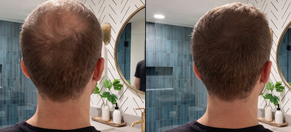 Prima — nuca con capelli corti prima e dopo l'applicazione di Rootia castano medio